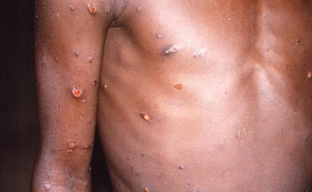 A man affected by monkeypox.